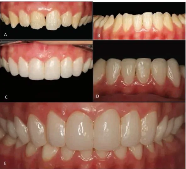 Figura 3 (adaptado sem a autorização do autor): A-dentes anteriores superiores afetados por  amelogénese imperfeita; B-dentes anteriores inferiores afetados por amelogénese imperfeita;  