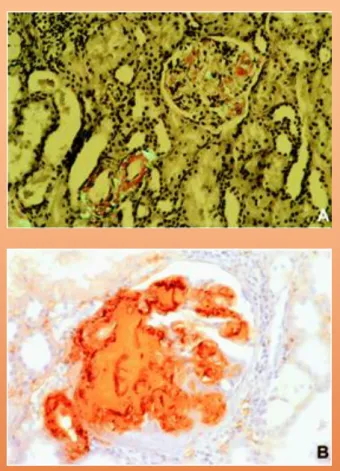Figura  8.  Biópsia  renal:  A.  Coloração  pelo  vermelho  do  Congo  positiva  na  presença  de  depósitos  de  amilóide  no  mesângio  e  artéria  interlobular,  adquirindo  birrefringência   verde-maçã  sob  luz  polarizada  (x200)