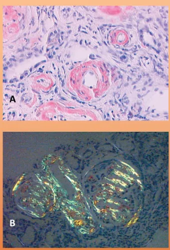 Figura  1.  Biópsia  renal:  A.  Coloração  pelo  vermelho  do  Congo  positiva  na  presença  de  depósitos  de  amilóide  no  mesângio  e  paredes  arteriais  (x200)
