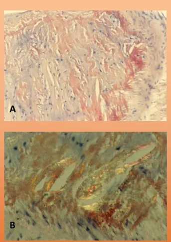 Figura  2.  Biópsia  endomiocárdica:  A.  Coloração  pelo  vermelho  do  Congo  positiva  (x  200)