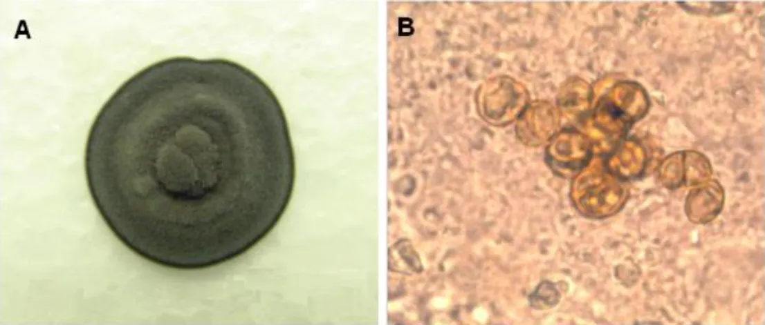 Figura  1.  A)  Cultura  de  F.  pedrosoi;  B)  Fotomicrografia  de  células  escleróticas  em  solução  de  hidróxido  de  potássio  10%,  obtidas  da  raspagem  direta  da  pele  lesionada  de  paciente  com  cromoblastomicose  (aumento  de  x1000)