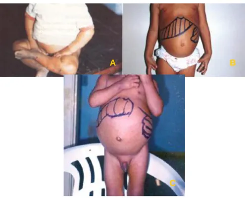 Figura  4.  Manifestações  clínicas  da  leishmaniose  visceral  em  crianças.  A:  Forma  oligossintomática