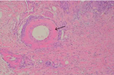 Figure 9 - Histopathology of a skin biopsy from a patient with CRGV, showing a dermal artery with  fibrinoid  necrosis  (arrow)