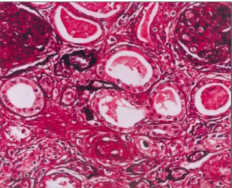 Figura  11.  Aparência  ao  M.O.C.  característica  da  nefropatia  do  transplante,  evidenciando  a  obliteração vascular, alterações glomerulares membranoproliferativas e atrofia tubular (Andrews, 2002) 