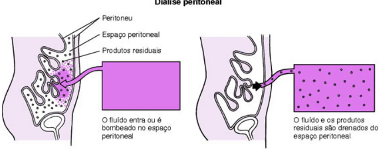 Figura 1: Ilustração da diálise peritoneal 