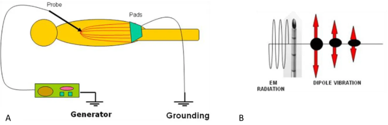 Figure  4  –  A:  RFA  ‘circuit’.  Electrode  acts  like  the  cathode  and  the  grounding  pads  as  the  anode