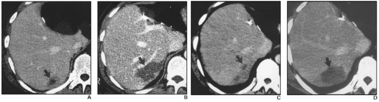 Figure  8  –  Results  of  several  studies  about  Percutaneous  Radiofrequency  Ablation  of  Hepatocellular  Carcinoma [12]