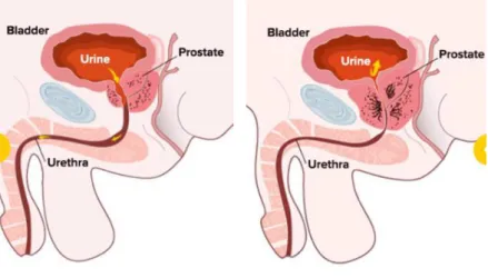 Figura 4. Aumento do volume da próstata e efeito sobre a uretra prostática.  