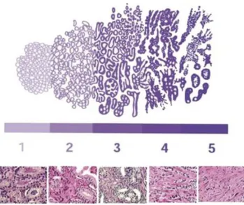 Figura 5. Escala de Gleason para a classificação histológica do adenocarcinoma da próstata, tendo em  conta  a  morfologia/arquitectura  tecidular,  a  diferenciação  tumoral,  e  as  respetivas  representações  histológicas exemplificativas