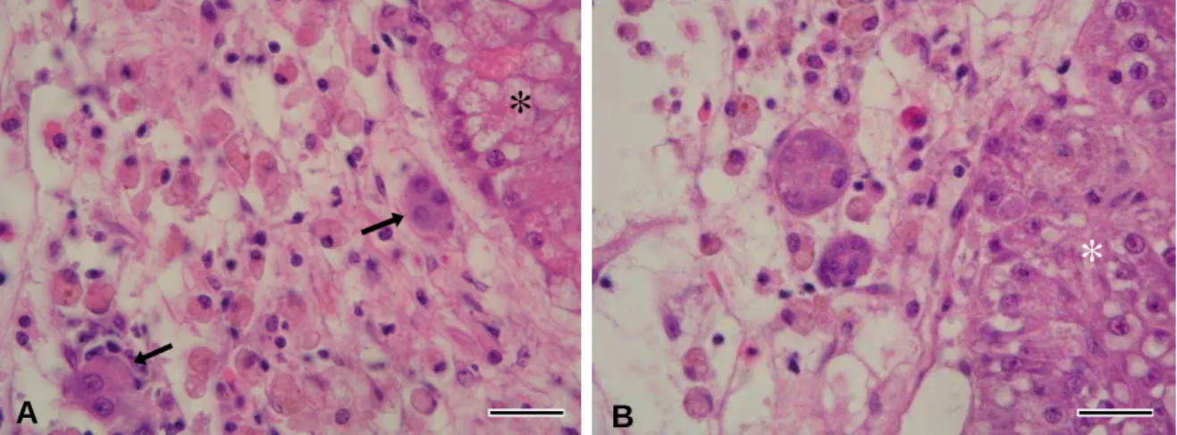 Figure  11  –  Features  of  a  malignant  hepatocellular  neoplasia  in  the  dab.    A  -  Islands  of  neoplastic hepatocytes (arrows) appeared in the border between the neoplastic tissue and  normal  parenchyma  (asterisk)