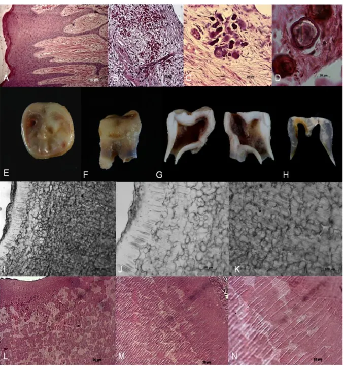 Figura  10 – Análise histológica amostras da Família Iː Lâmina histológica de tecido gengival do paciente 2 (VIː2) mostrando  acantose no epitélio (Fig