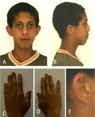 Figura  15 –  Fotos  ao  exame  clínico  do  Paciente  4  (IVː5)  apresentando  microcefalia,  retração  bitemporal,  fendas  palpebrais retas, raiz nasal alta, hipoplasia da face média,  retrognatia,  cabelos  crespos  e  de  implantação  baixa  na  nuca 