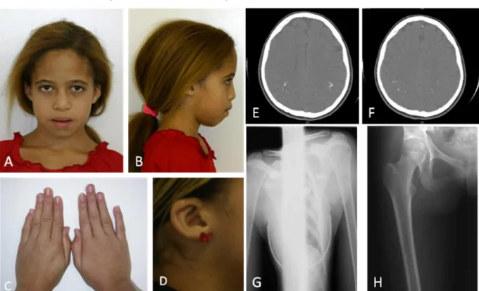 Figura  17 –  Fotos  ao  exame  clínico,  tomografia  de  crânio  e  raio  X  de  ossos    do  Paciente  5  (IVː6):  apresentando  perímetro  cefálico  normal, fronte  ampla,  fendas  palpebrais  retas,  raiz  nasal  alta,  lábios  grossos,  hipoplasia da 
