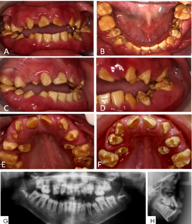 Figura  18  –  Manifestações  bucais  ao  exame  clínico  e  radiográfico  do  Paciente  5  (IVː6):  apresentando  dentes  amarelo- amarelo-amarronzados,  com  superfície  pontilhada  em  pré-molares  e  molares,  exceto  nas  superfícies  oclusais  de  mo