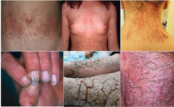 Figure  5  |  Clinical  manifestations  of  Darier  disease  patients.  A  Reddish,  greasy,  crusted  papules  on  the  abdomen