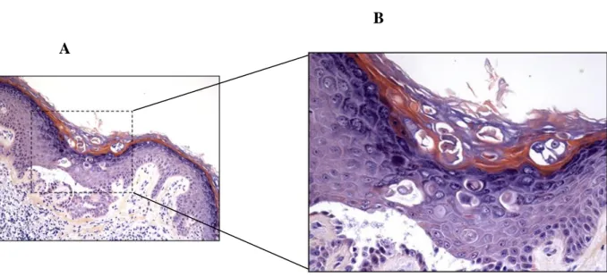 Figure 6 | Histological section of Darier disease skin. Skin biopsy from Darier disease where a suprabasal cleft  of  the  epidermis  formed  by  acantholytic  cells  can  be  observed,  as  well  rounded  dyskeratotic  cells  with  a  dark  nucleus, so ca