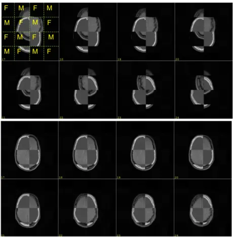Fig. 6. Registration of two 3D images. Top: corresponding slices before the registration process  – each slice shown was built using patches (F and M) that were cut from each input image 