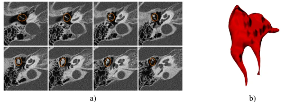 Fig. 11. 3D visualization of the incus and malleus surface built (b) from the automated segmen- segmen-tation based on image registration of 3D CT images (a) (the ossicles 