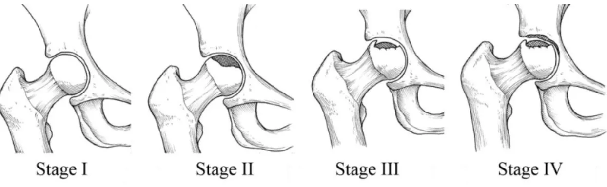 Figure 8 show an example of four stages of osteonecrosis, represented by these authors