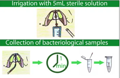 Figure 1.1.   Collection of Bacteriological Samples. Cavity is first irrigated with 5mL of sterile  saline solution