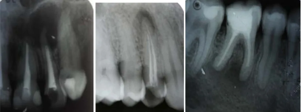 Figure 2.7 – Examples of persistent endodontic infections 