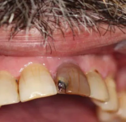 Figure 4.1 -  Necrotic teeth 