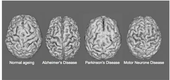 Figure 2. 1 – Brain image illustrating different kinds of effects on the brain of different kinds of NDs