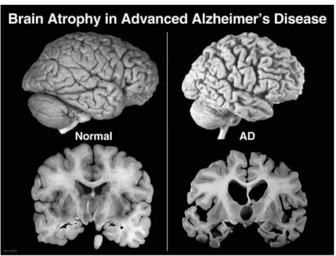 Figure 2. 3 – Brain atrophy in advanced AD in comparison with a normal brain. (http://alzheimerdisease.tv/wp- (http://alzheimerdisease.tv/wp-content/uploads/2014/11/alzheimers-disease-term.jpg) 