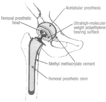 Figure 3.5 – A total hip arthroplasty with the use of methylmethacrylate cement to fix the  prosthetic femoral and acetabular components to the bony structures (Siopack e Jergesen 