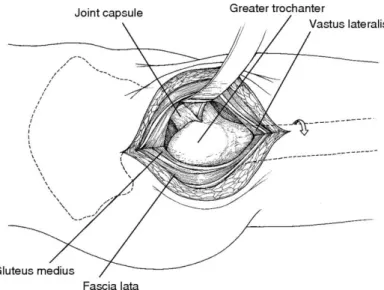 Figure 3.6 – Antero external hip incision (Vail e Callaghan 2007). 