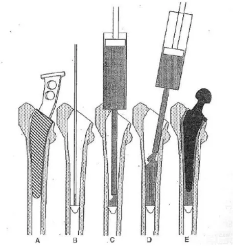 Figure 3.8 - Technique for application of cement of second generation. (A) Scraping in pre- pre-calculated caliber