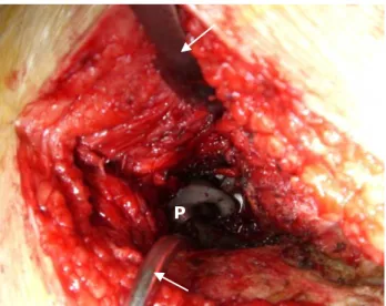 Figure 5.1 – Prosthesis (P) during a surgery. 