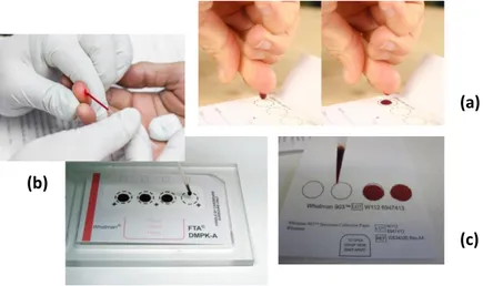 Figura 1 – Técnicas de amostragem utilizadas nas DBS: (a) aplicação do sangue diretamente do dedo ou  calcanhar para o papel de filtro; (b) recolha do sangue e aplicação no papel de filtro recorrendo a um capilar 