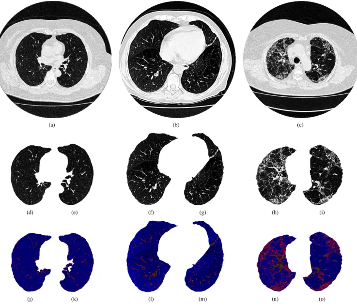 Fig. 1. Examples of the chest CT images used for diagnosing lung diseases: a)-c) original images, d)-e) healthy lungs, f)-g) lungs with emphysema, h)-i) lungs with fibrosis, and j)-o) map of AHTD lung features.