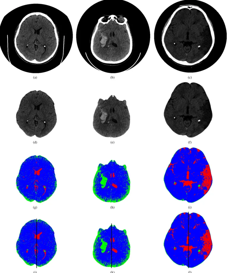 Fig. 2. Examples of the CT brain images used for diagnosing brain diseases: a)-c) original images, d) healthy brain, e) brain with hemorrhagic stroke, f) brain with ischemic stroke, g)-i) maps of AHTD brain features, and j)-l) brains divided into two regio