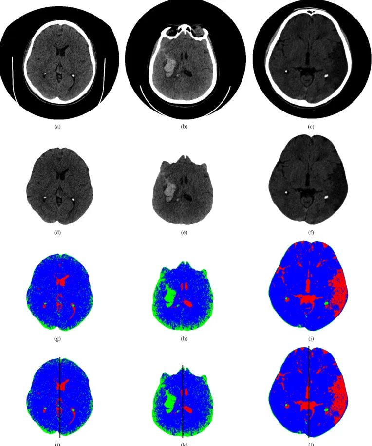 Fig. 2. Examples of the CT brain images used for diagnosing brain diseases: a)-c) original images, d) healthy brain, e) brain with hemorrhagic stroke, f) brain with ischemic stroke, g)-i) maps of AHTD brain features, and j)-l) brains divided into two regio