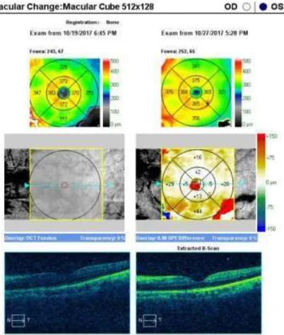 Fig. 11 – OCT macular OE no dia 27/10 