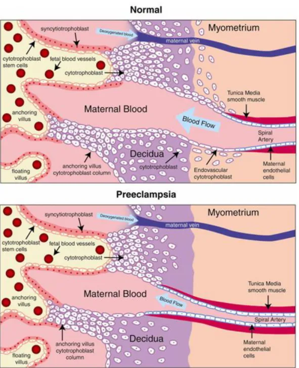 Figura 1: Formação anormal da placenta na pré-eclâmpsia.(16)  