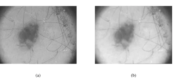 Figure 3.2: Application of anisotropic diffusion filter: a) original dermoscopy image of a melanoma and b) corresponding image after this filtering.