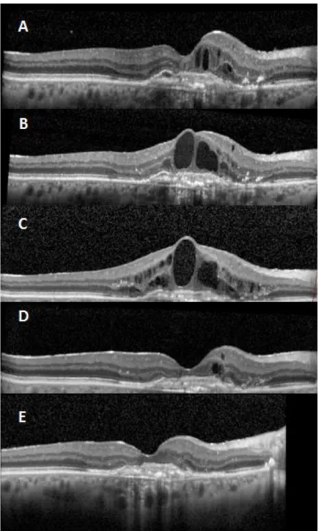 Fig.  1.  Patient  initially  treated  with  bevacizumab  (group  1)  that  ended developing resistance to the drug (A and B)