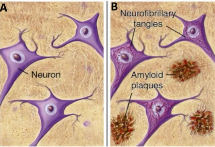 Figure 1 - Schematic representation of (A) healthy neurons and (B) the abnormal deposits described by  Dr