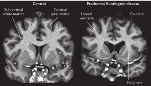 Figure  2.  Atrophy  in  prodromal  HD  shown  using  7T  MRI.  Bilateral  atrophy  of  the  caudate  and  putamen, and a concomitant increase in size of the fluid-filled lateral ventricle, is observed in the gene  carrier compared with the control