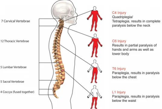 Figure 2.11: Diagram of different paralysis types as a result of a SCI. Adapted from [16].
