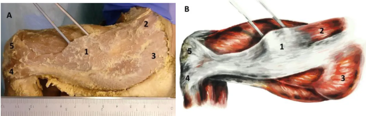 Fig. 1 Anatomic dissection of the knee and thigh. Iliotibial band (1) and its insertions at the tensor fascia lata (2),  gluteus maximus muscle (3), Gerdy's tubercle (4) and patella (5)