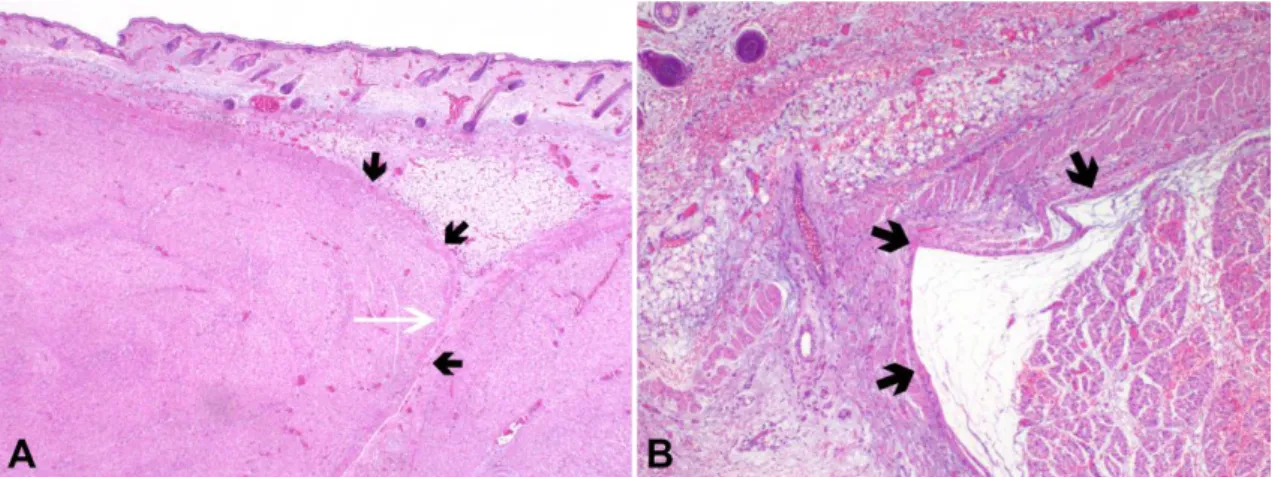 Fig. 2 HE, 100X (A) and 200X (B) – The iliotibial tract is constituted by a continuous cellular band of immature  fibroblasts  (black  small  arrows),  extending  underneath  the  fibroadipocitic  layer  of  subcutaneous  tissue  and  continuing with the i