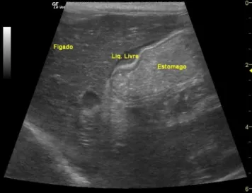 Figura 8- Derrame peritoneal de pequeno volume localizado entre o fígado e o estômago.