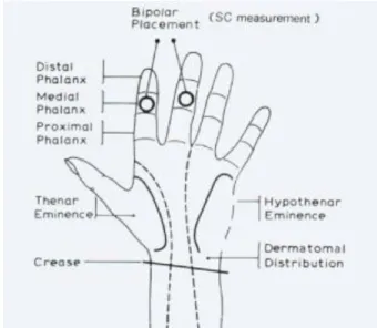 Figure 7- Bipolar placement of the SC (Source: 