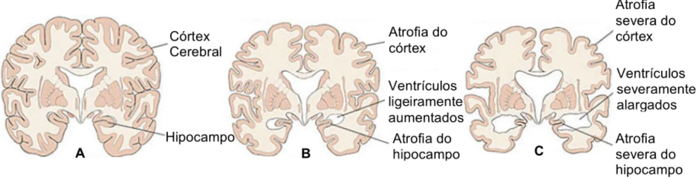 Figura 3.2 – Progressão da doença de Alzheimer. A: Cérebro Saudável. B: Cérebro que apresenta um ligeiro  comprometimento cognitivo (MCI)