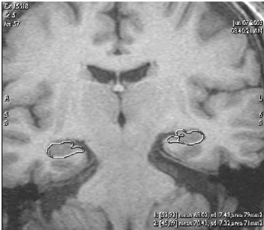 Figura 5.1 – Exemplo de uma imagem de RM com a segmentação manual do hipocampo, esquerdo e direito,  efectuada por um médico no plano coronal