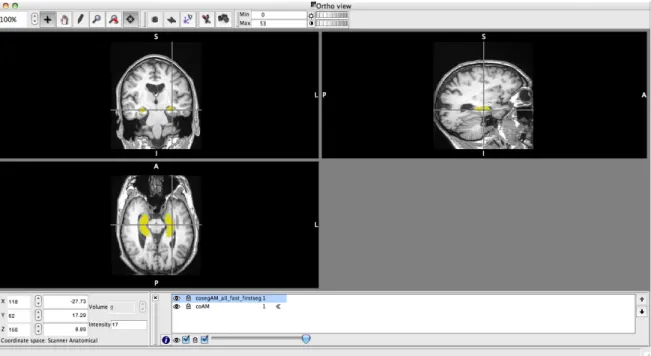 Figura 5.4 – Interface do FSL, fslview, que mostra as estruturas pretendidas segmentadas nos diferentes  planos